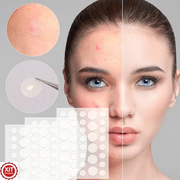 Пластир від прищів та акне 72шт Acne Patch / Косметичні патчі від бородавок та папілом / Пластирі наклейки 0234574162 фото