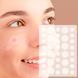 Пластир від прищів та акне 72шт Acne Patch / Косметичні патчі від бородавок та папілом / Пластирі наклейки 0234574162 фото 3